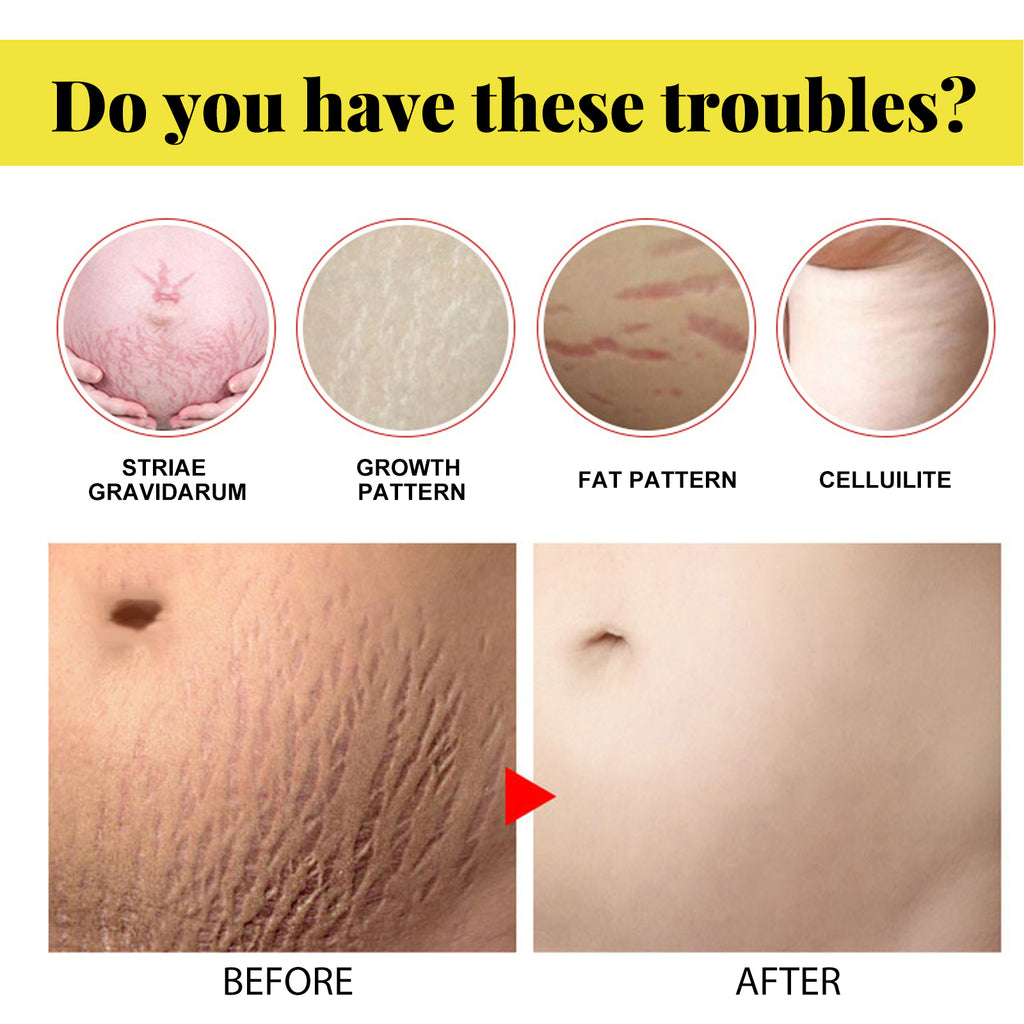 Skin Care Cream, Pregnant Women's Body Skin Gentle Repair Daily Care Moisturizing Moisturizer